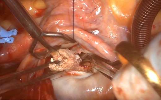 Atheromatous calcification lesion around P2 part of mitral valve.