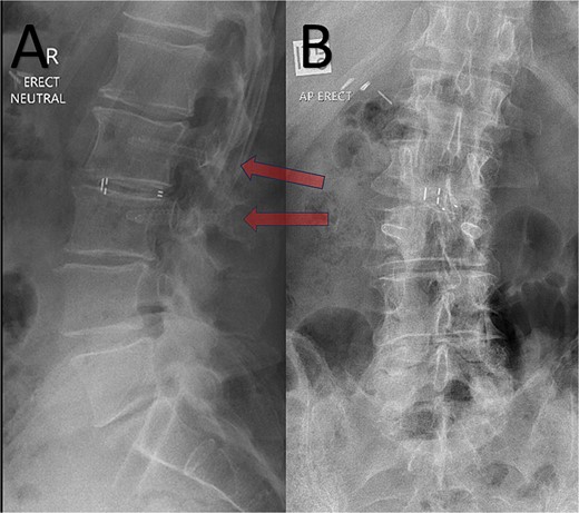 Post-operative erect XR lumbar spine after L2/3 lumbar fusion. Arrow = CFRP pedicle screws. A – Sagittal; B – Anteroposterior views.