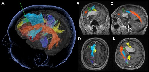 Tubular retractor-assisted minimally invasive parafascicular surgery approach: Pre-operative tractography demonstrating the relationship of the left Sylvian fissure-centered dermoid to the corticospinal tract (dark blue), frontal-aslant tract (light blue), cingulate (yellow) and arcuate fasciculus (orange).
