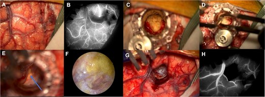 Surgical workflow: Left superior frontal sulcus dissection (A) with preservation of the cortical vasculature of the adjacent gyri shown by the ICG with the infrared image on the Zeiss KINEVO 900© microscope (B); introduction of the NICO BrainPath©, dissection of the dermoid capsule and visualization of the dermoid contents (C); the contents of the cyst were removed (D) and anatomical structures such as the optic nerve (blue arrow) were visualized through the dermoid cyst capsule (E); the endoscope was used at the end of the drainage to visualize remnants of the cyst and they were further washed and removed (F); the tubular retractor was removed (G) and the preservation of the cortical vasculature after the procedure was verified with the use of ICG (H).