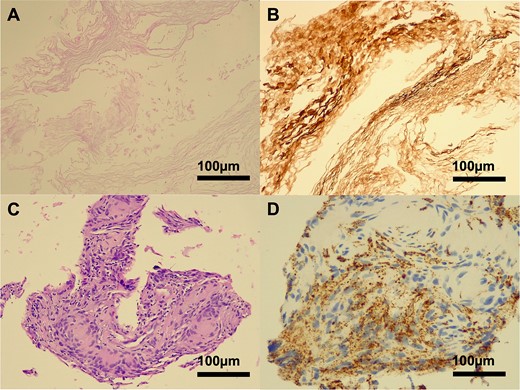 Histopathology of a ruptured keratinous cyst. Hematoxylin-eosin (H&E) staining demonstrated a lamellar arrangement of necrotic keratin (A), confirmed by immunohistochemistry (B) for pan-cytokeratin (MNF116). A cluster of foreign body type macrophages was identified on H&E staining (C), with CD68 positivity (D). No viable epithelial lining was present in the biopsy specimen.