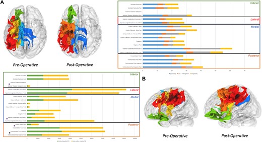 Tractography analysis: a tractography analysis of the peritumoral tracts and those located around the surgical corridor was performed before and after tumor resection. An improvement in the morphology of the frontal aslant tract and SLF I (both volume and area) and a successful dissection of the anterior thalamic radiations was verified after surgery alongside with a deterioration of the superior corticalstriatal tract (A). With regards to the microstructural metrics, we observed no significant differences between the preoperative and the postoperative tractography of the analyzed tracts.