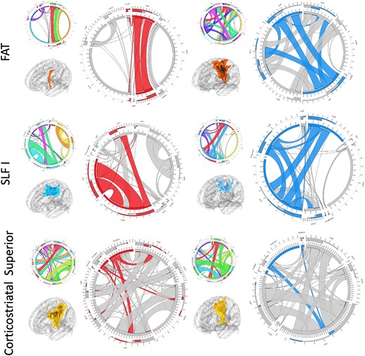 Connectivity analysis: a connectivity analysis of the tracts with changes in the morphometry was performed. We observed an improvement of the connectivity of both fronto-aslant tract (FAT) and SLF I around the surgical tract—FAT showed increased connectivity in the superior frontal gyrus and the SLF I in the superior and middle frontal gyri. For the corticostriatal gyrus, we observed decrease connectivity to the basal ganglia. Red—predominant preoperative connectivity; blue—predominant postoperative connectivity