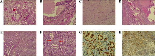 A) The teratoma predominantly comprises benign thyroid tissue (hematoxylin and eosin stain, magnification 100×). B) Higher magnification shows a focal duct-like structure lined by ciliated epithelium (hematoxylin and eosin stain, magnification 400×). C) Another focus demonstrates mature glial tissue (hematoxylin and eosin stain, magnification 40×). D) The section depicts normal thyroid tissue on the right transitioning into papillary thyroid carcinoma on the left (hematoxylin and eosin stain, magnification 100×). E) A small focus of papillary projections with numerous crowded follicular structures, indicative of papillary thyroid carcinoma (hematoxylin and eosin stain, magnification 100×). F) High-power view shows crowded follicular structures with enlarged, optically clear nuclei that show occasional pseudoinclusions (arrows), features characteristic of papillary thyroid carcinoma (hematoxylin and eosin stain, magnification 400×). G) Immunohistochemical stain for TTF1 demonstrating strong, diffuse, nuclear staining in the crowded follicles (diaminobenzidine chromogen, magnification 400×). H) Immunohistochemical stain for PAX-8 showing a strong, diffuse, nuclear staining pattern in the crowded glands (diaminobenzidine chromogen, magnification 100×)