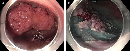 (A) Half circumferential, partially obstructing rectal mass measuring 60 mm in diameter (pictured on the left). (B) Post EMR partially resected polyp with residual central 25 mm polyp.