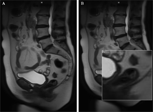 Images from the MRI abdomen pelvis with contrast. This depicts a small polypoid enhancing 2.2 cm mass within the posterior wall of the left mid rectum without invasion of the muscularis propria. The image on the right is a zoomed in image of the remaining polyp.