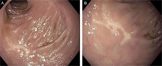 Images from the 6-month follow-up flexible sigmoidoscopy. A large, well-healed scar from the EMR/TEMS resection without residual or recurrent polyp.