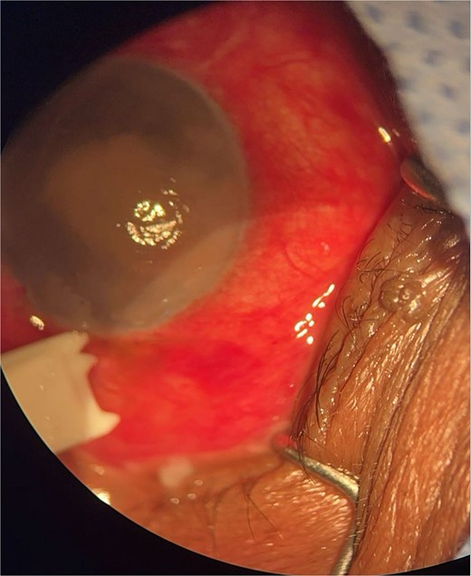 Surgical microscope examination showing hypopyon, chemosis, and conjunctival injection in patient 1.