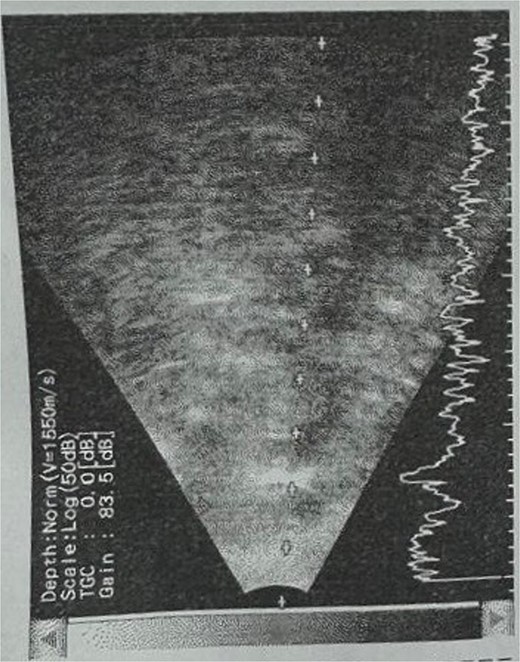 B-scan ultrasound showing sever vitreous echoes and vitreous abscess in patient 5.
