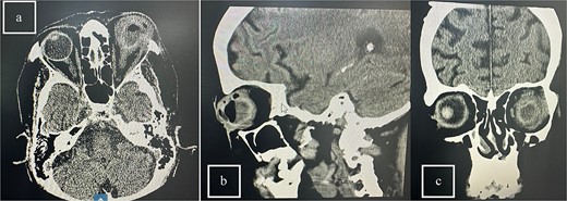 CT scans of the orbit for patient 5 showing (a) coronal view with dense fluid content and air-fluid leveling, (b) axial view with edematous changes in the intra-conal fat, and (c) sagittal view with involvement of the extra-ocular muscles.