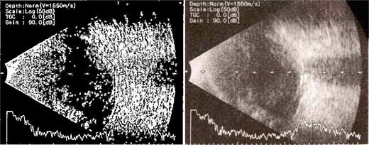 B-scan ultrasound demonstrating mild to moderate vitritis in endophthalmitis case in patient 1.