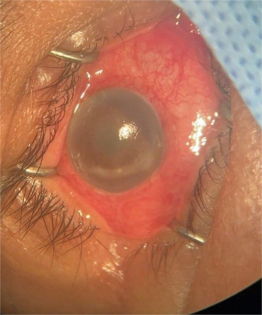Surgical microscope examination showing hypopyon, chemosis, ciliary, and conjunctival injection in patient 2.