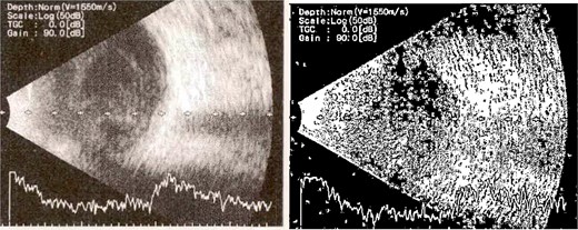 B-scan ultrasound showing moderate vitreous echoes and vitreous abscess in patient 2.