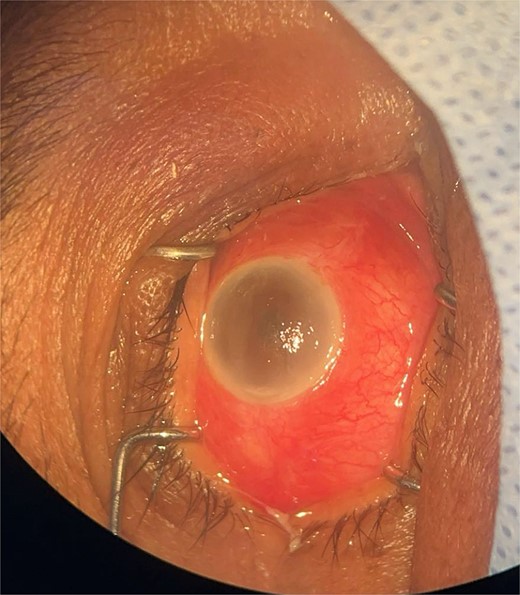 Surgical microscope examination showing hypopyon, chemosis, ciliary, and conjunctival injection in patient 3.