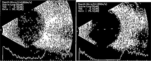B-scan ultrasound demonstrating mild to moderate vitritis in endophthalmitis case for patient 3.