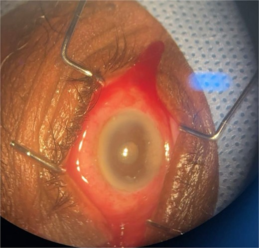 Surgical microscope examination showing hypopyon, chemosis, ciliary, and conjunctival injection in patient 4.
