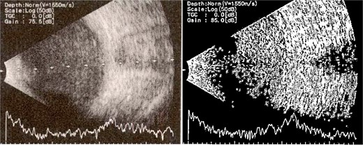 B-scan ultrasound demonstrating moderate vitreous echoes and vitreous abscess in patient 4.