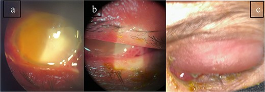 Slit lamp examination of patient 5 showing (a) corneal haziness, (b) severe chemosis and ciliary injection, and (c) severe redness and swelling of the left upper lid.