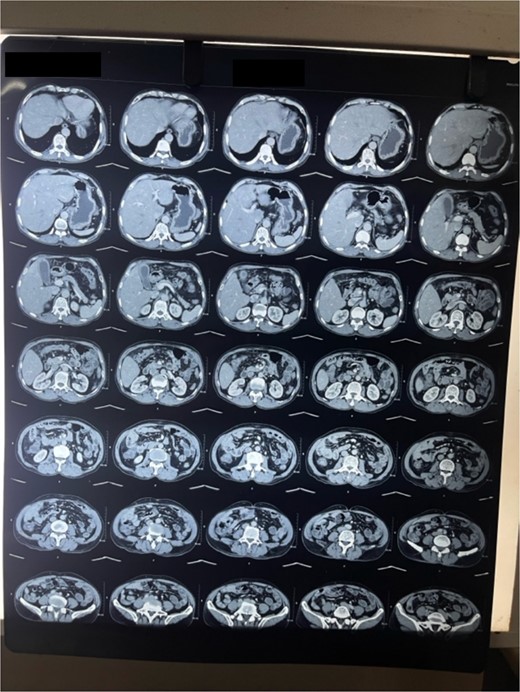 CT abdomen and pelvis transverse cut shows thickened GB wall.