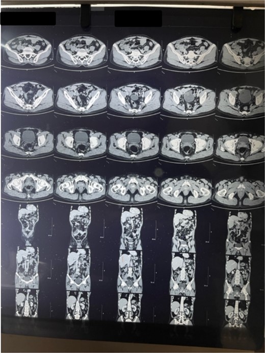 CT coronal cut abdomen and pelvis shows thickened wall.