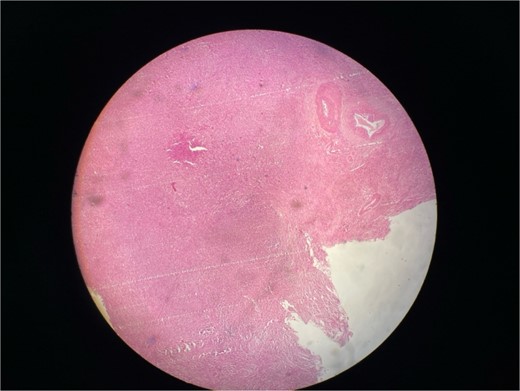 Microscopic picture shows polygonal eosinophilic cells arranged in clusters and diffusely infiltrates the surrounding cell.