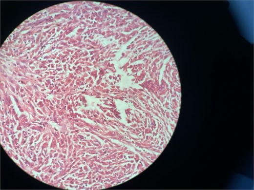 High resolution image shows polygonal cells with granular cytoplasm with vesicular small centrally located nucleus.