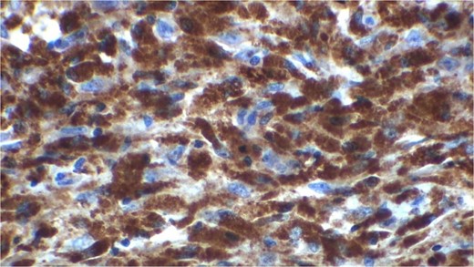 CD 68 positivity (KP 1).