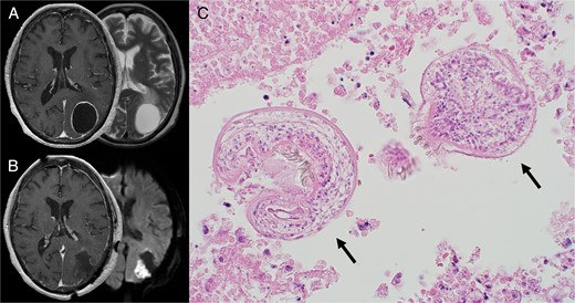 (A) Preoperative MRI. Axial contrast-enhanced T1-weighted (left) and T2-weighted MRI (right) demonstrated a ring-enhancing cystic lesion in the left parietal lobe with edema extending ventrally. (B) Postoperative MRI. Axial contrast-enhanced T1-weighted image (left) showed complete cyst resection. Diffusion-weighted image (right) showed cerebral infarction adjacent to the cyst wall caused by vascular injury during the operation. (C) HE staining of the cyst showed two protoscoleces (black arrows). Alt text: Preoperative MRI images of brain Echinococcosis at the top left and postoperative MRI images showing complete cyst resection at the bottom left. A microscopic image on the right is a Hematoxylin and eosin (H&E) stained specimen showing two protoscoleces.