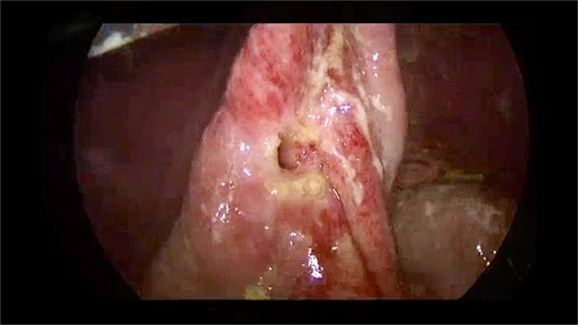 Perforation in gastro-jejunal anastomosis.