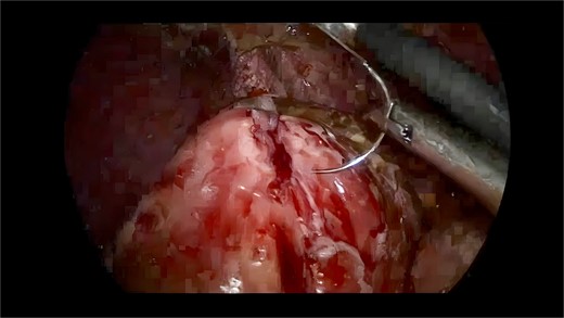 Debrided ulcer margins.