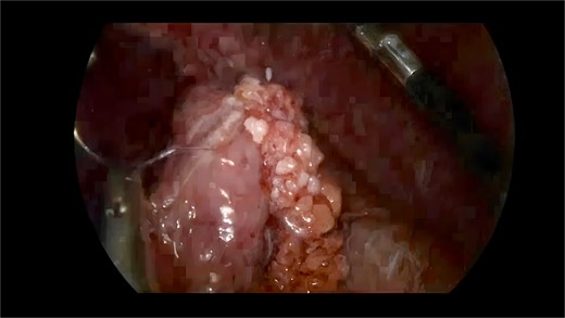 Defect closed with absorbable suture.