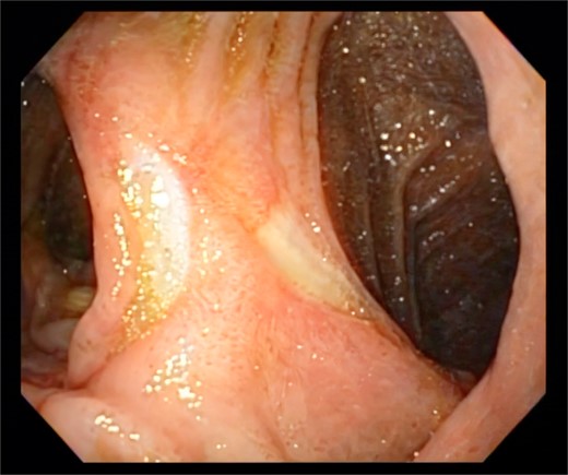 Persistent ulcer 6 months later.