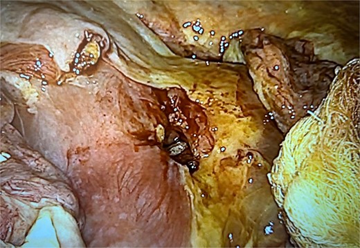 Case 2 perforation ulcer.