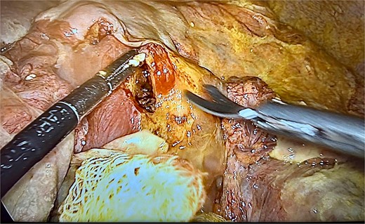 Case 2 debrided ulcer.