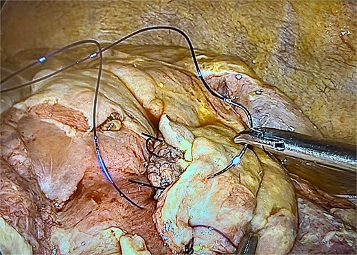 Defect closed reinforced by an omental patch.