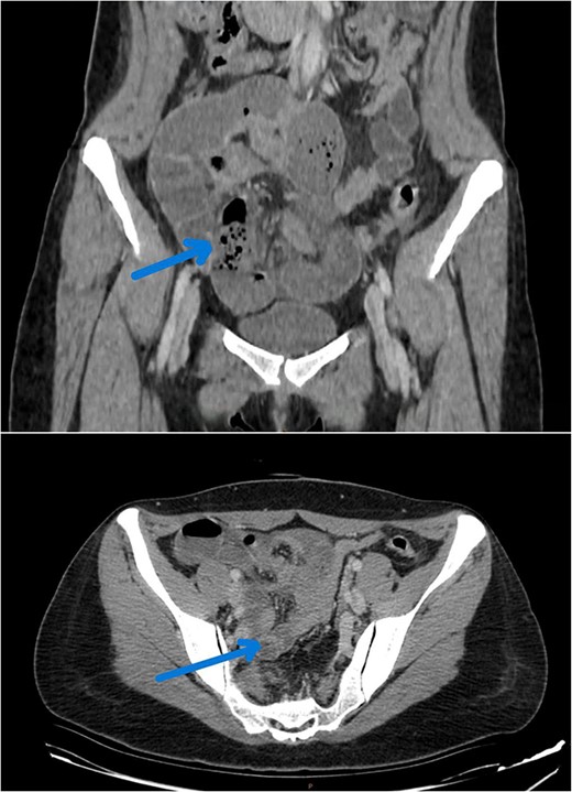 CT image reveals a closed dialed loop localized to the right of the uterus (arrow).