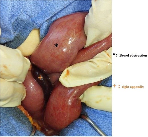 Intraoperative image showing a bowel obstruction with herniation of the right broad ligament.
