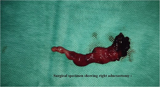 Shows the specimen removed during the salpingectomy procedure, with a portion of the necrotic fallopian tube excised.