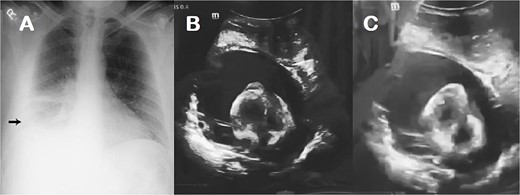 Chest X-ray (A) and echocardiogram (B & C) with evidence of pleural and pericardial effusion.