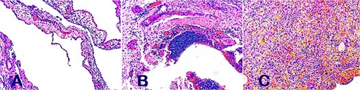 Histopathological analysis of papillary endothelial hyperplasia compatible with pericardial lymphangioma on (A, B, and C).