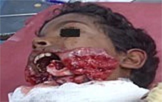 Patient at time of initial presentation with open wound.