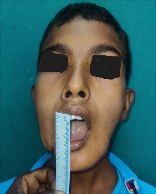 Postoperative image showing mouth opening.