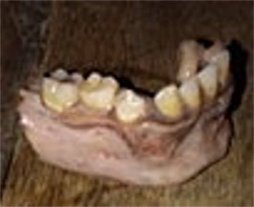 Avulsed segment of mandible.