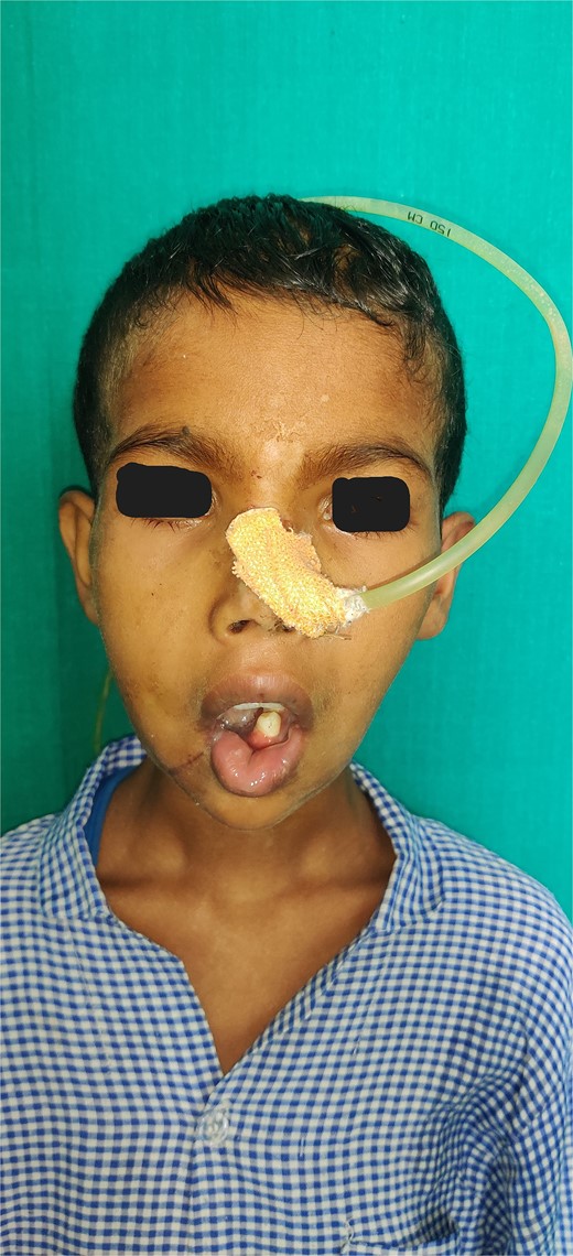 Clinical image of patient showing inability to close mouth completely.