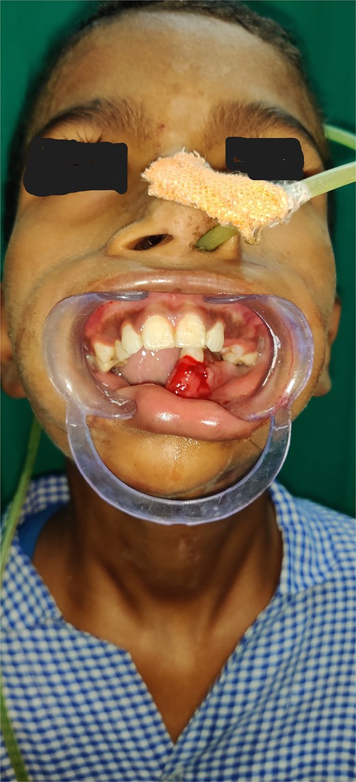 Intra-oral clinical image showing lost mandibular segment.