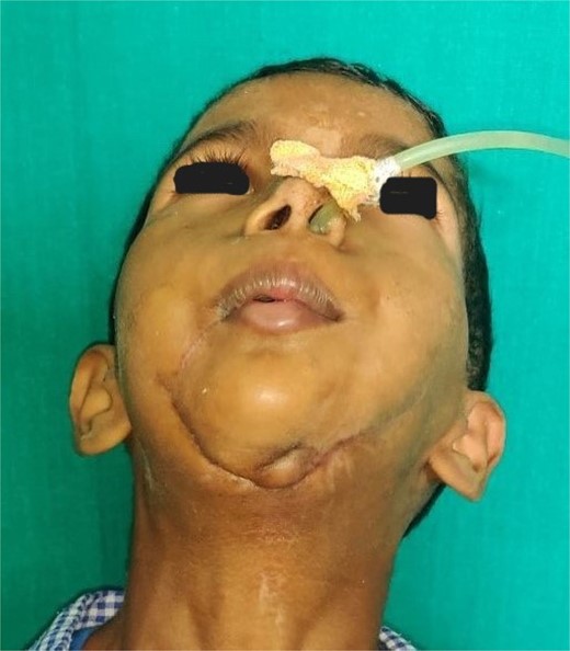 Clinical image showing healed scar over chin indicating site of primary closure.