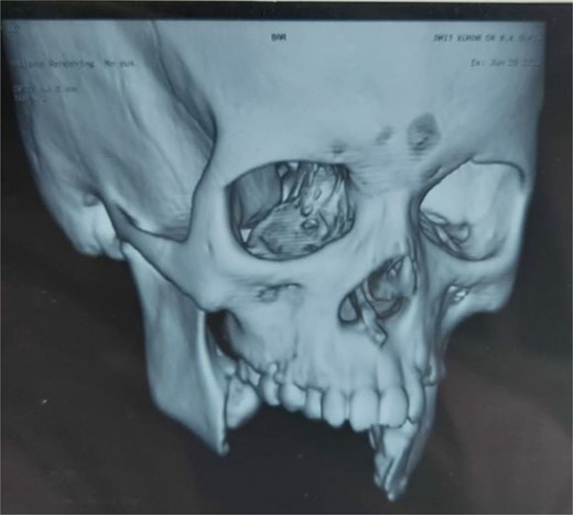 NCCT face with 3D reconstruction showing loss of symphysis and right-side body of the mandible.