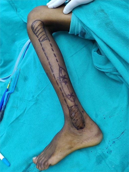 Preoperative marking of peroneal artery perforators using hand-held Doppler along with skin paddle.