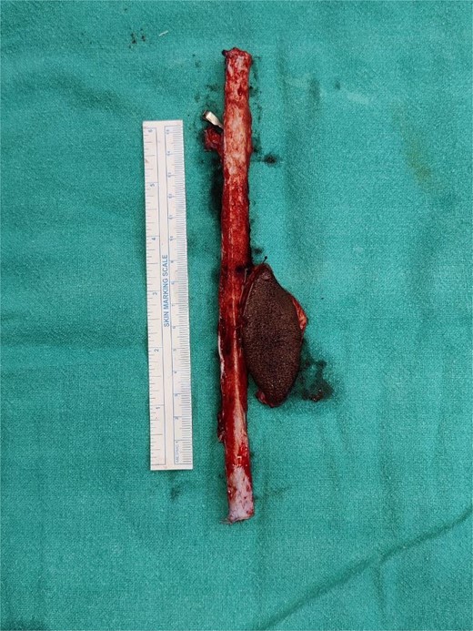 Harvested fibula along with skin paddle.