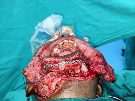 Fixation of free fibula flap with a 16-hole titanium plate.
